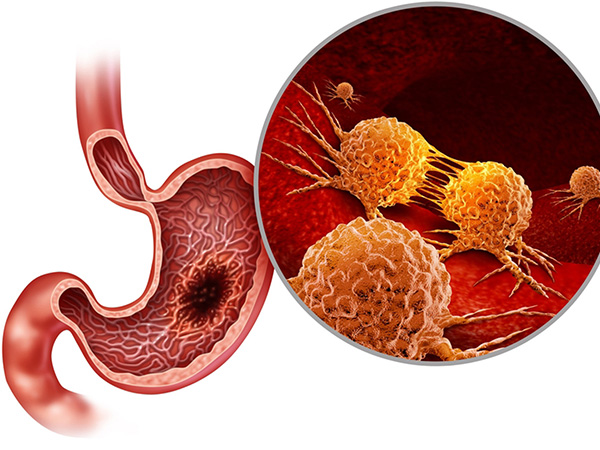 GI Ulcer Treatment